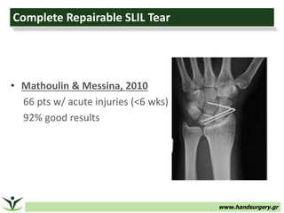 www.handsurgery.gr
Complete Repairable SLIL Tear
• Mathoulin & Messina, 2010
66 pts w/ acute injuries (<6 wks)
92% good results
 