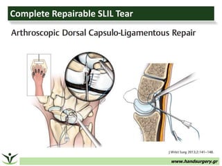 www.handsurgery.gr
Complete Repairable SLIL Tear
 