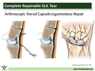 www.handsurgery.gr
Complete Repairable SLIL Tear
 