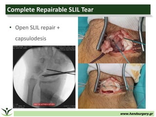 www.handsurgery.gr
Complete Repairable SLIL Tear
• Open SLIL repair +
capsulodesis
 