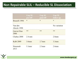 www.handsurgery.gr
Non Repairable SLIL – Reducible SL Dissociation
 