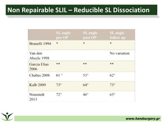 www.handsurgery.gr
Non Repairable SLIL – Reducible SL Dissociation
 