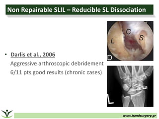 www.handsurgery.gr
Non Repairable SLIL – Reducible SL Dissociation
• Darlis et al., 2006
Aggressive arthroscopic debridement
6/11 pts good results (chronic cases)
 