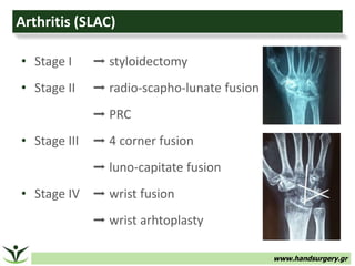 www.handsurgery.gr
Arthritis (SLAC)
• Stage I ➡ styloidectomy
• Stage II ➡ radio-scapho-lunate fusion
➡ PRC
• Stage III ➡ 4 corner fusion
➡ luno-capitate fusion
• Stage IV ➡ wrist fusion
➡ wrist arhtoplasty
 