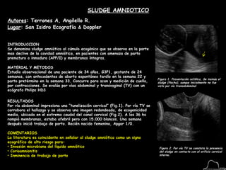 SLUDGE AMNIOTICO Autores : Terrones A, Angilello R. Lugar : San Isidro Ecografía  &  Doppler   INTRODUCCION Se denomina sludge amniótico al cúmulo ecogénico que se observa en la parte mas declive de la cavidad amniótica, en pacientes con amenaza de parto prematuro o inmaduro (APP/I) y membranas íntegras. MATERIAL Y METODOS Estudio observacional de una paciente de 34 años, G3P1, gestante de 24 semanas, con antecedentes de aborto espontáneo tardío en la semana 22 y parto pretérmino en la semana 33. Concurre para scan y medición de cuello, por contracciones. Se evalúa por vías abdominal y transvaginal (TV) con un ecógrafo Philips HD3 RESULTADOS Por vía abdominal impresiona una “tunelización cervical” (Fig.1). Por vía TV se corrobora el hallazgo y se observa una imagen redondeada, de ecogenicidad media, ubicada en el extremo caudal del canal cervical (Fig.2). A las 36 hs rompió membranas, estaba afebril pero con 15.000 blancos. Una semana después inició trabajo de parto. Recién nacido femenino, Apgar 1/0. Figura 1. Presentación cefálica. Se insinúa el sludge (flecha), aunque inicialmente no fue visto por vía transabdominal Figura 2. Por vía TV se constata la presencia del sludge en contacto con el orificio cervical interno. ,[object Object],[object Object],[object Object],[object Object],[object Object]