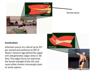 Acceleration:
Extension occurs at a rate of up to 25º
per second and continues to 20º of
flexion. Forearm lags behind the upper
arm and generates valgus stress (> 60
Nm), The valgus force can overcome
the tensile strength of the UCL and
cause either chronic microscopic tears
or acute rupture.
Tensile stress
 