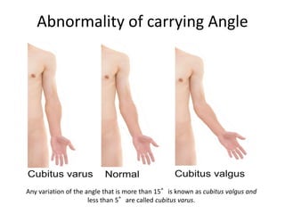 Abnormality of carrying Angle
Any variation of the angle that is more than 15°is known as cubitus valgus and
less than 5°are called cubitus varus.
 