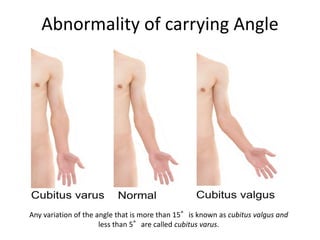 Abnormality of carrying Angle
Any variation of the angle that is more than 15°is known as cubitus valgus and
less than 5°a...