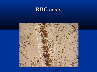 Small vessel vasculitis | PPT