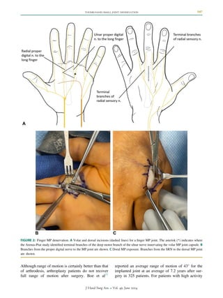 Small-Joint-Denervation-of-the-Hand-and-Thumb-Base.pdf