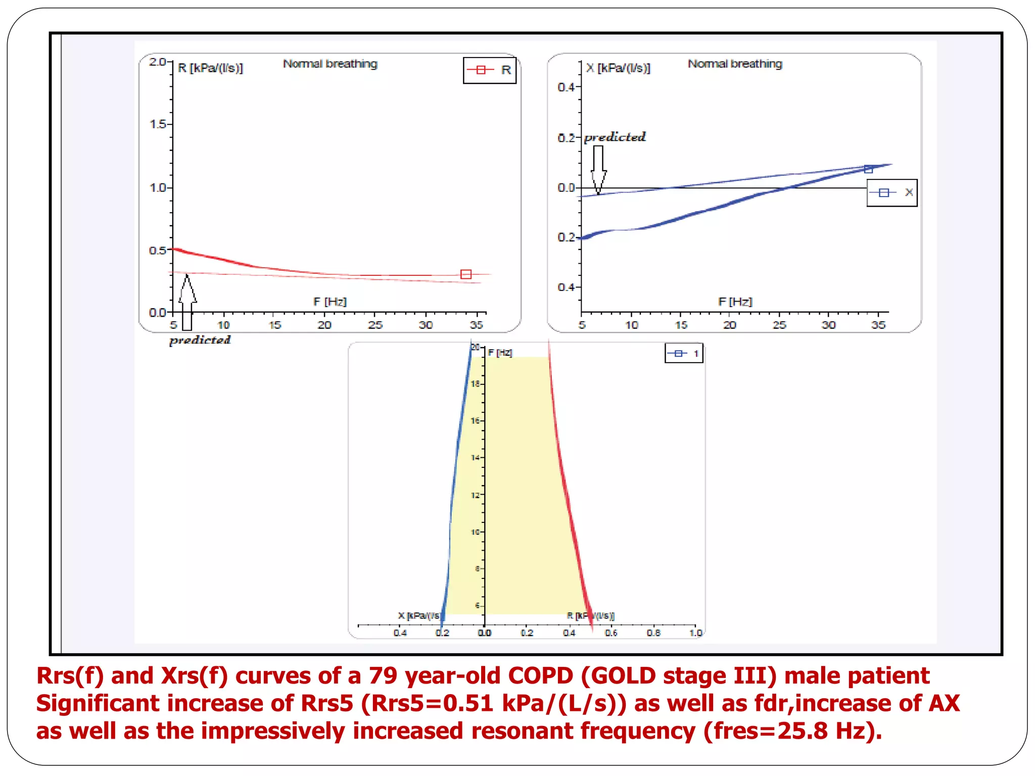 Rrs(f) and Χrs(f) curves of a 79 year-old COPD (GOLD stage III) male patient
Significant increase of Rrs5 (Rrs5=0.51 kPa/(L/s)) as well as fdr,increase of ΑΧ
as well as the impressively increased resonant frequency (fres=25.8 Ηz).
 