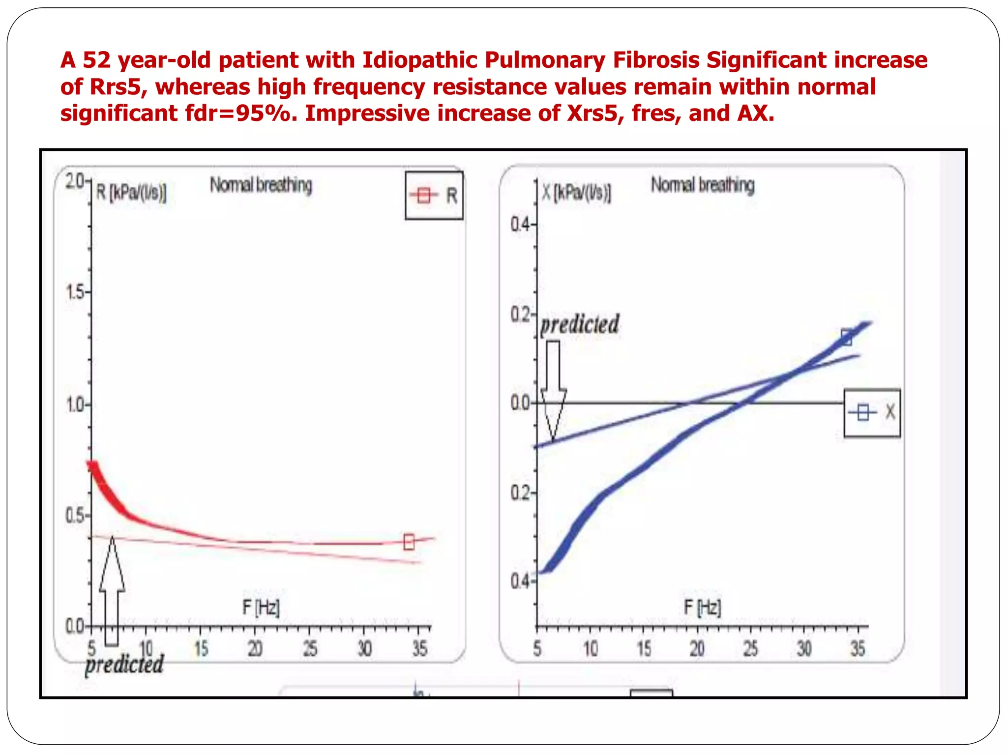 A 52 year-old patient with Idiopathic Pulmonary Fibrosis Significant increase
of Rrs5, whereas high frequency resistance values remain within normal
significant fdr=95%. Impressive increase of Xrs5, fres, and ΑΧ.
 