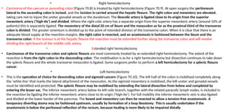 • Right hemicolectomy
• Carcinoma of the caecum or ascending colon (Figure 70.8) is treated by right hemicolectomy (Figure 70.9). At open surgery the peritoneum
lateral to the ascending colon is incised, and the incision is carried around the hepatic flexure. The right colon and mesentery are elevated,
taking care not to injure the ureter, gonadal vessels or the duodenum. The ileocolic artery is ligated close to its origin from the superior
mesenteric artery (‘high-tie’) and divided. Where the right colic artery has a separate origin from the superior mesenteric artery (around 10% of
patients) this is separately ligated. The mesentery of the distal 20 cm of ileum and the mesocolon as far as the proximal third of the transverse
colon is divided. The greater omentum is divided up to the point of intended division of the transverse colon. When it is clear that there is an
adequate blood supply at the resection margins, the right colon is resected, and an anastomosis is fashioned between the ileum and the
transverse colon. If the tumour is at the hepatic flexure the resection must be extended further along the transverse colon and will involve
dividing the right branch of the middle colic artery.
• Extended right hemicolectomy
• Carcinomas of the transverse colon and splenic flexure are most commonly treated by an extended right hemicolectomy. The extent of the
resection is from the right colon to the descending colon. The mobilisation is as for a right hemicolectomy but dissection continues to take down
the splenic flexure and the whole transverse mesocolon is ligated. Some surgeons prefer to perform a left hemicolectomy for a splenic flexure
cancer.
• Left hemicolectomy
• This is the operation of choice for descending colon and sigmoid cancers (Figure 70.10). The left half of the colon is mobilised completely along
the ‘white line’ that marks the lateral attachment of the mesocolon. As the sigmoid mesentery is mobilised, the left ureter and gonadal vessels
must be identified and protected. The splenic flexure may be mobilised by extending the lateral dissection from below and completed by
entering the lesser sac. The inferior mesenteric artery below its left colic branch, together with the related paracolic lymph nodes, is included in
the resection by ligating the inferior mesenteric artery close to its origin (‘high-tie’). For full mobility the inferior mesenteric vein is also ligated
and divided at the lower border of the pancreas. The bowel and mesentery can then be resected to allow a tension-free anastomosis. A
temporary diverting stoma may be fashioned upstream, usually by formation of a loop ileostomy. This is usually undertaken if the
anastomosis is below the peritoneal reflection of the rectum, because healing is more likely to be impaired distally
 