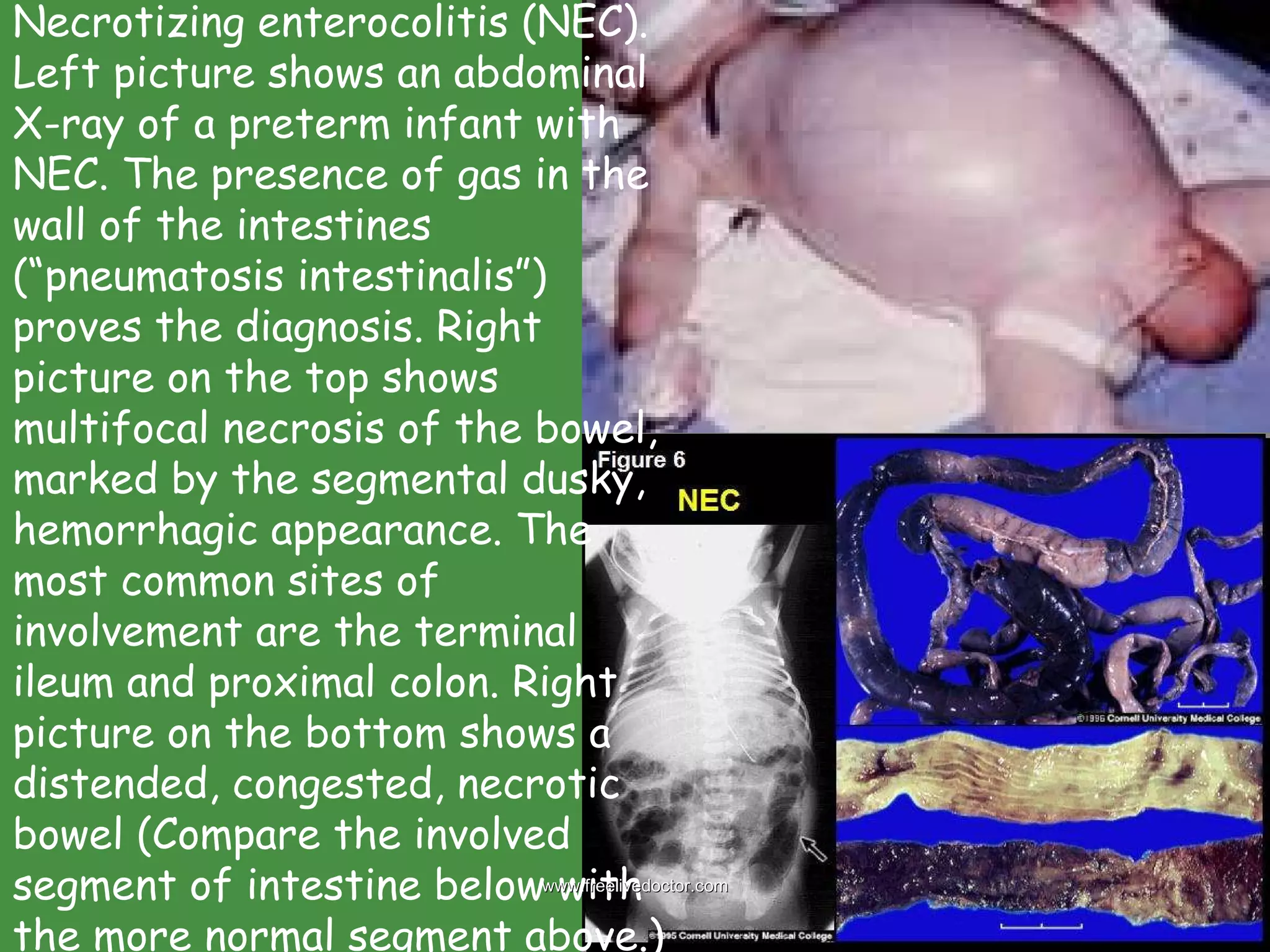 Necrotizing enterocolitis (NEC). Left picture shows an abdominal X-ray of a preterm infant with NEC. The presence of gas in the wall of the intestines (“pneumatosis intestinalis”) proves the diagnosis. Right picture on the top shows multifocal necrosis of the bowel, marked by the segmental dusky, hemorrhagic appearance. The most common sites of involvement are the terminal ileum and proximal colon. Right picture on the bottom shows a distended, congested, necrotic bowel (Compare the involved segment of intestine below with the more normal segment above.)  www.freelivedoctor.com 