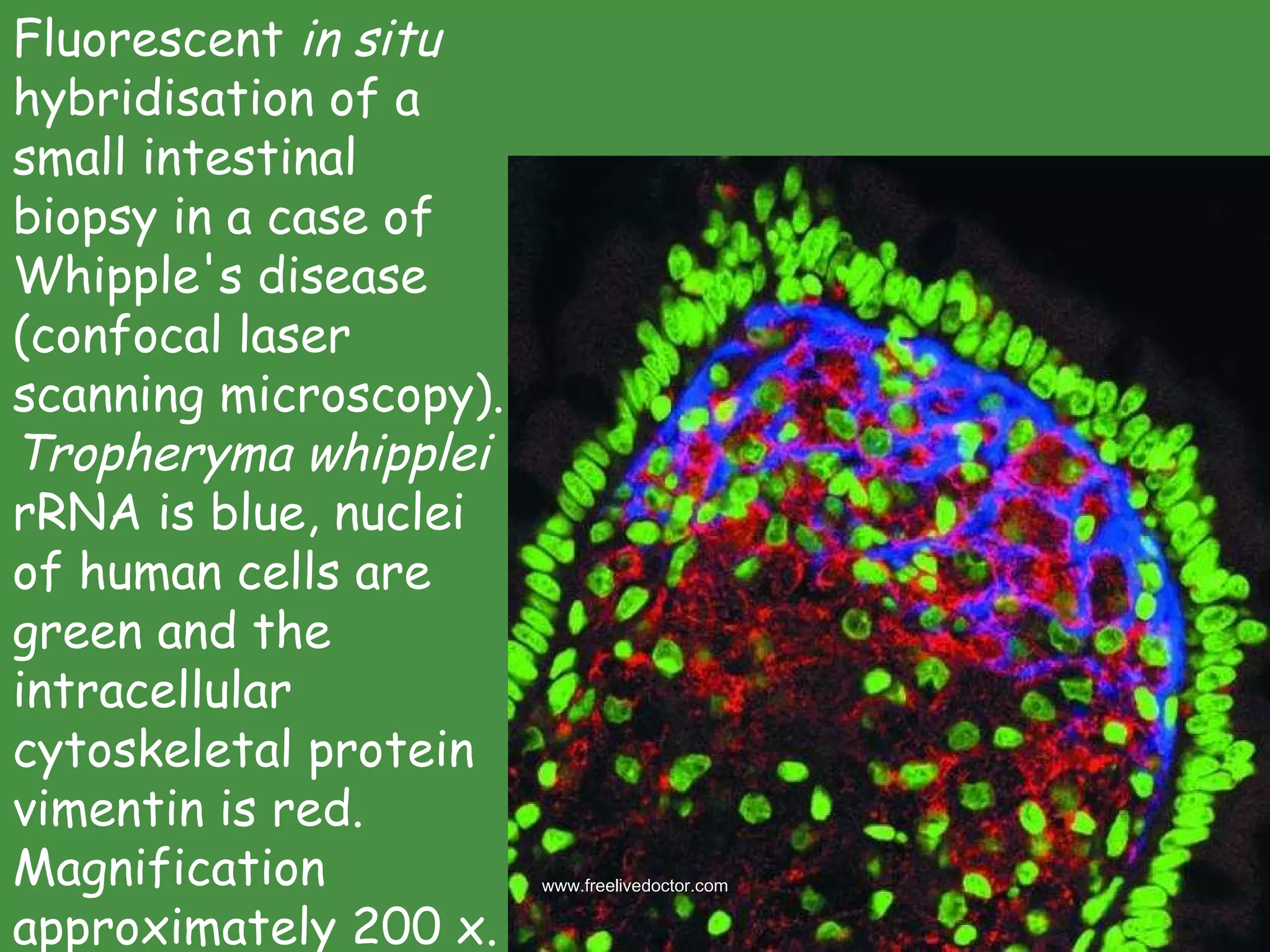 Fluorescent  in situ  hybridisation of a small intestinal biopsy in a case of Whipple's disease (confocal laser scanning microscopy).  Tropheryma whipplei  rRNA is blue, nuclei of human cells are green and the intracellular cytoskeletal protein vimentin is red. Magnification approximately 200 x.  www.freelivedoctor.com 