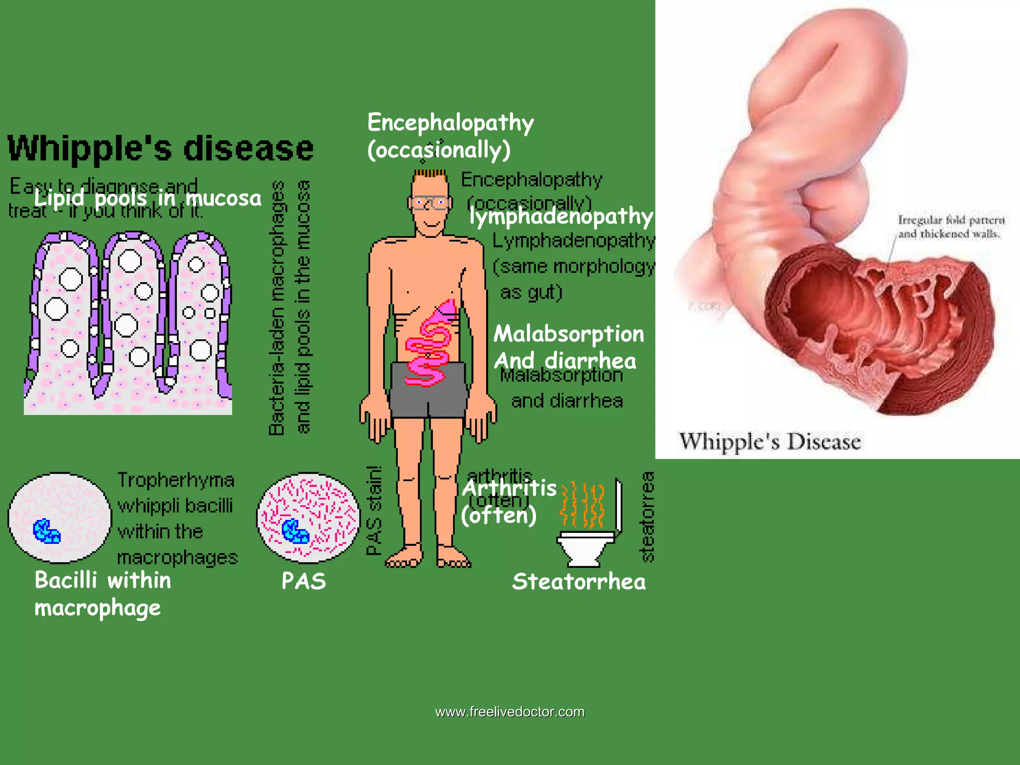 PAS Bacilli within macrophage Arthritis (often) Steatorrhea  Encephalopathy (occasionally)  Malabsorption And diarrhea lymphadenopathy Lipid pools in mucosa www.freelivedoctor.com 
