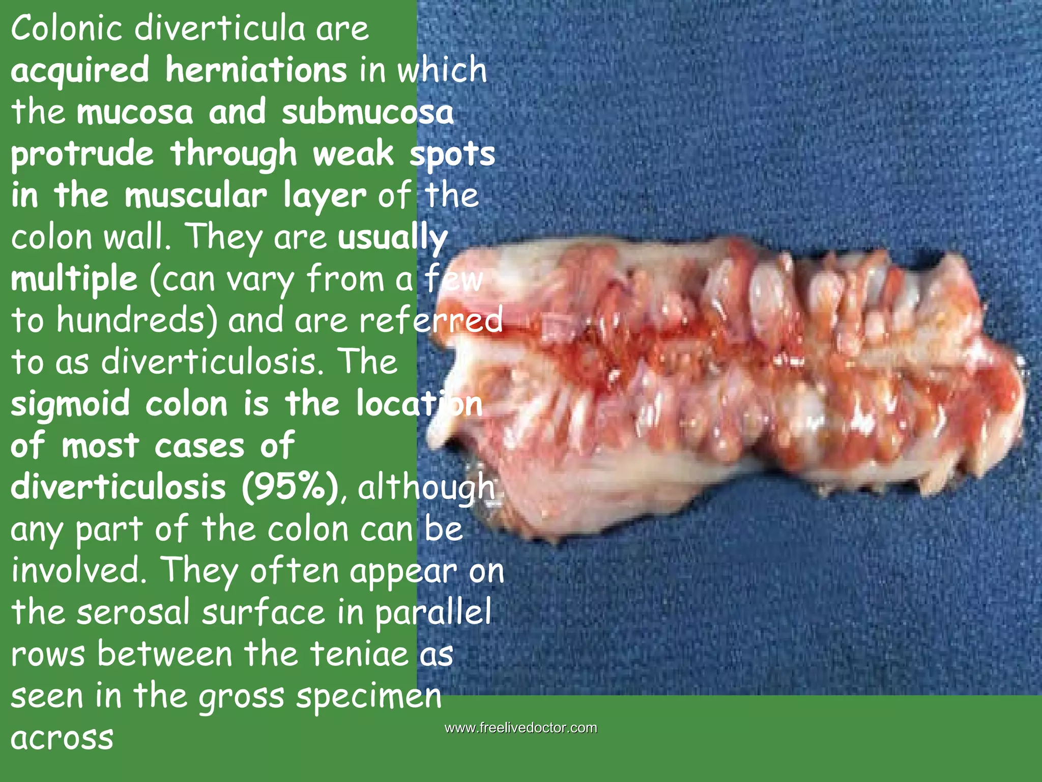 Colonic diverticula are  acquired herniations  in which the  mucosa and submucosa protrude through weak spots in the muscular layer  of the colon wall. They are  usually multiple  (can vary from a few to hundreds) and are referred to as diverticulosis. The  sigmoid colon is the location of most cases of diverticulosis (95%) , although any part of the colon can be involved. They often appear on the serosal surface in parallel rows between the teniae as seen in the gross specimen across  www.freelivedoctor.com 
