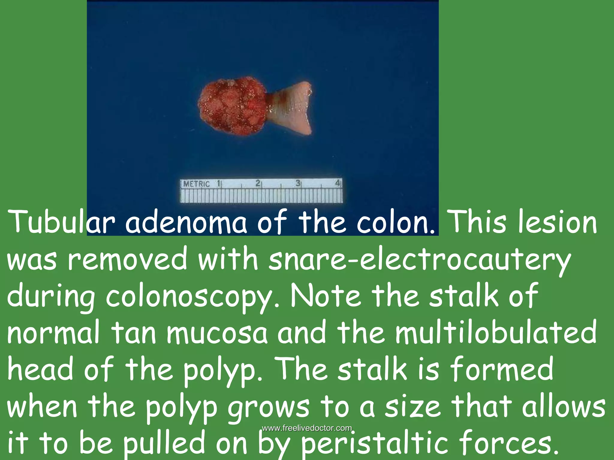Tubular adenoma of the colon. This lesion was removed with snare-electrocautery during colonoscopy. Note the stalk of normal tan mucosa and the multilobulated head of the polyp. The stalk is formed when the polyp grows to a size that allows it to be pulled on by peristaltic forces.  www.freelivedoctor.com 