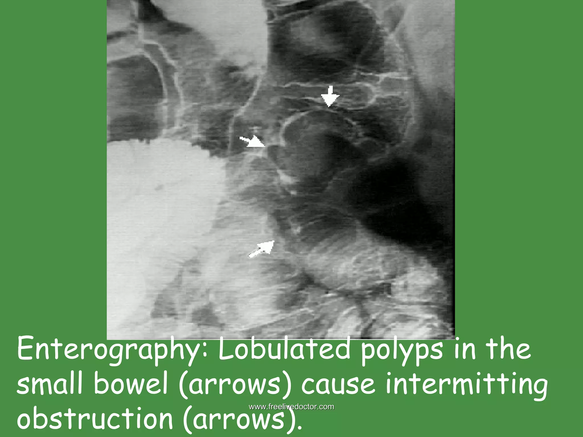 Enterography: Lobulated polyps in the small bowel (arrows) cause intermitting obstruction (arrows).  www.freelivedoctor.com 