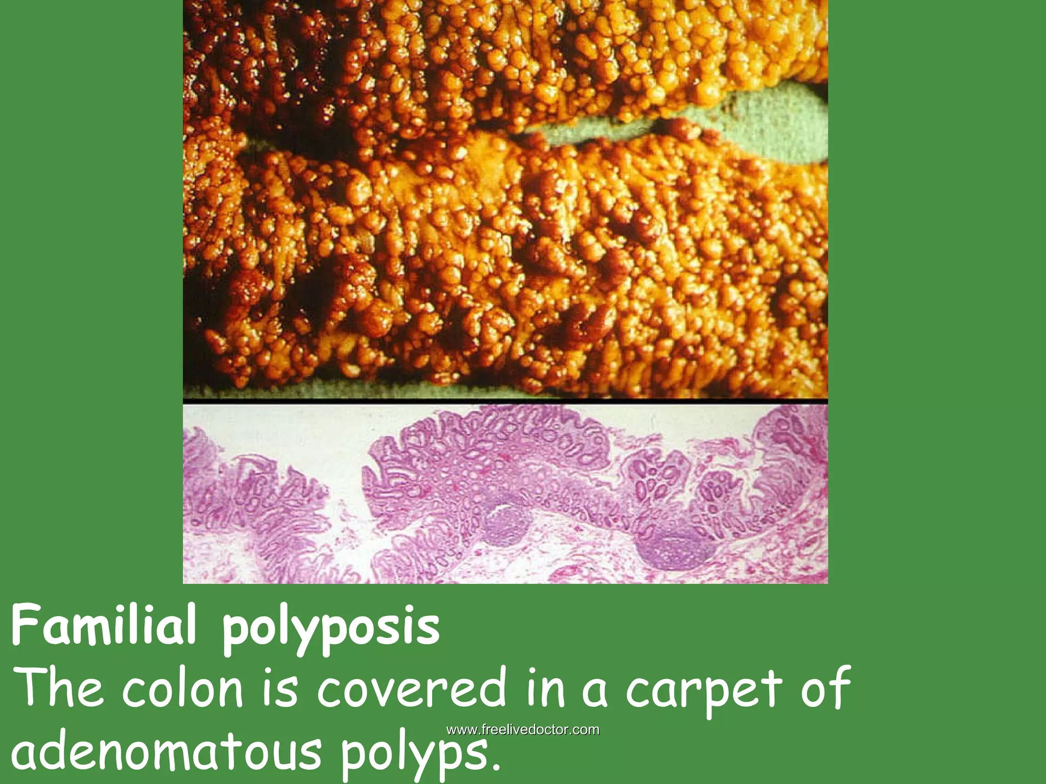 Familial polyposis The colon is covered in a carpet of adenomatous polyps.  www.freelivedoctor.com 