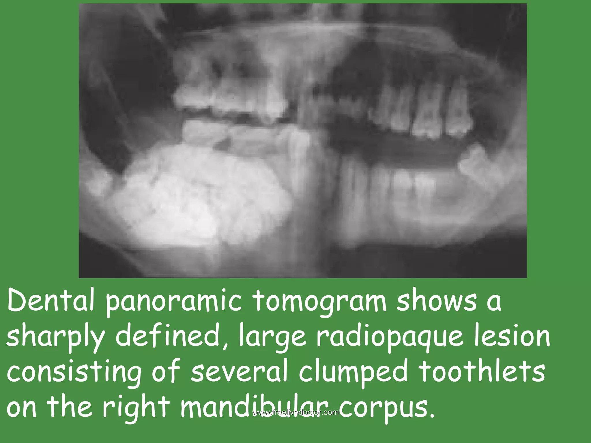 Dental panoramic tomogram shows a sharply defined, large radiopaque lesion consisting of several clumped toothlets on the right mandibular corpus.  www.freelivedoctor.com 
