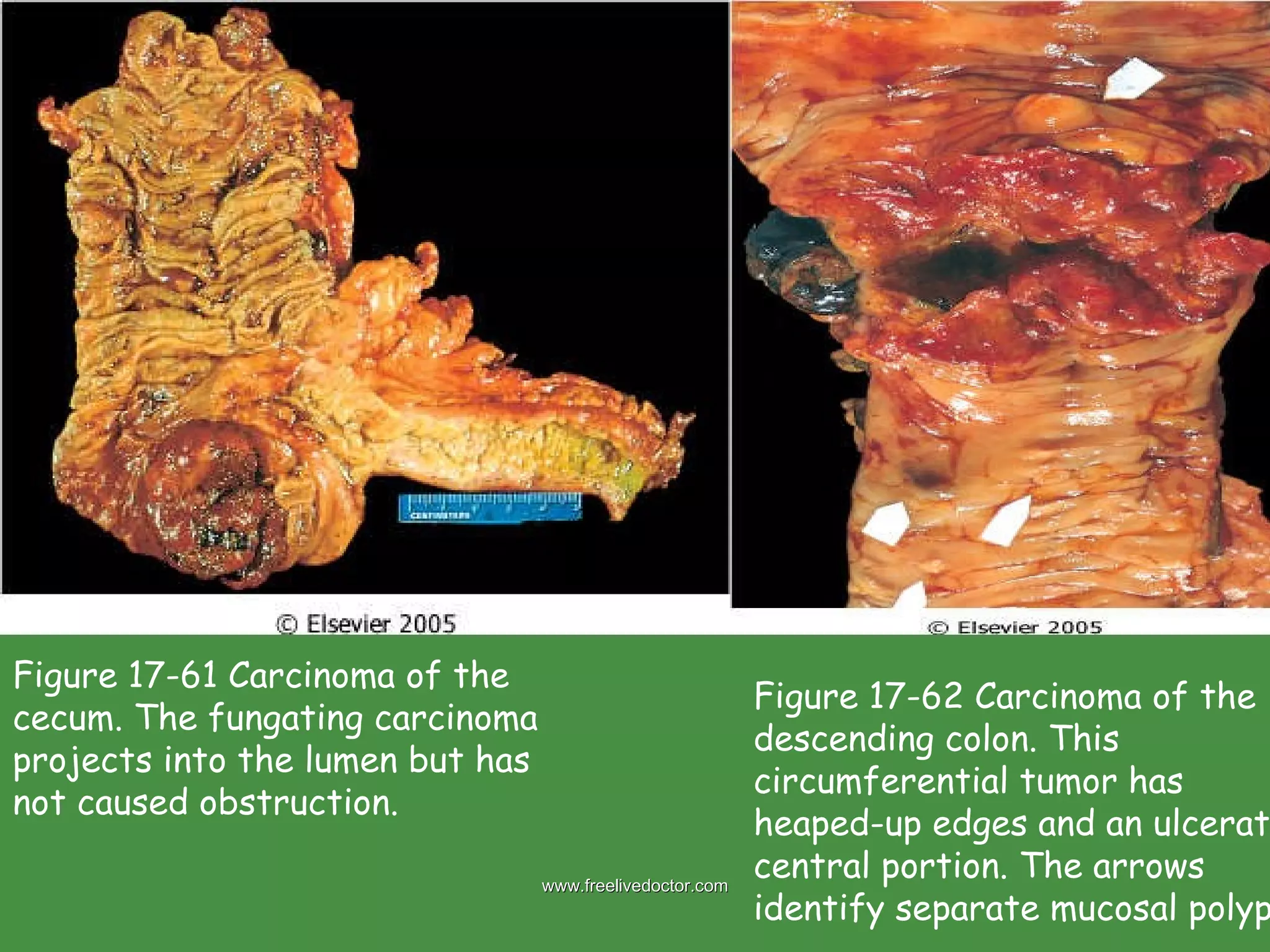 Figure 17-61 Carcinoma of the cecum. The fungating carcinoma projects into the lumen but has not caused obstruction. Figure 17-62 Carcinoma of the descending colon. This circumferential tumor has heaped-up edges and an ulcerated central portion. The arrows identify separate mucosal polyps. www.freelivedoctor.com 
