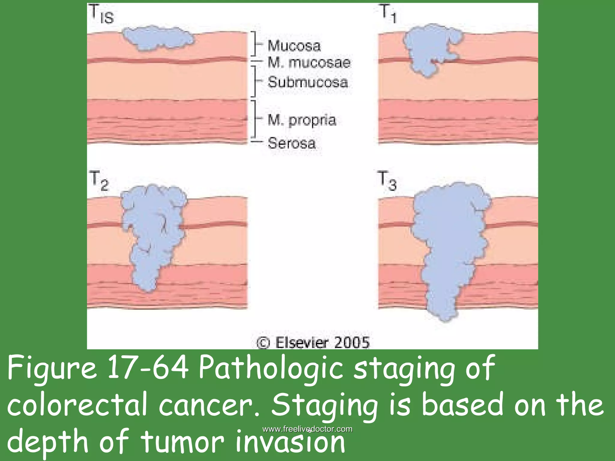 Figure 17-64 Pathologic staging of colorectal cancer. Staging is based on the depth of tumor invasion www.freelivedoctor.com 