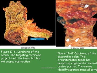 Small And Large Intestine Pathology PPT