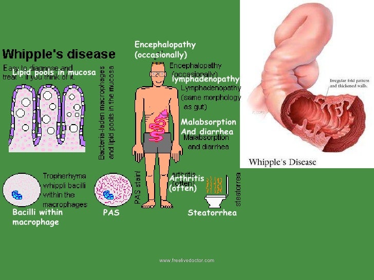 Small and large intestine pathology