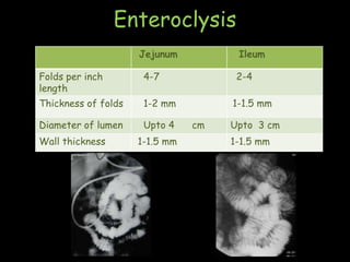 Enteroclysis
Jejunum Ileum
Folds per inch
length
4-7 2-4
Thickness of folds 1-2 mm 1-1.5 mm
Diameter of lumen Upto 4 cm Upto 3 cm
Wall thickness 1-1.5 mm 1-1.5 mm
 