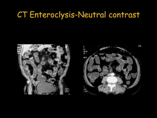 CT Enteroclysis-Neutral contrast
 