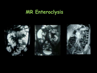 MR Enteroclysis
 