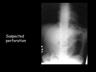 Suspected
perforation
 