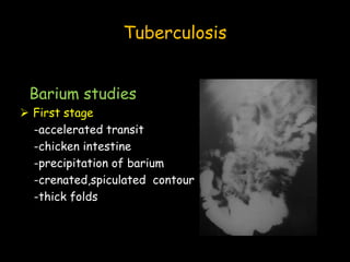 Tuberculosis
Barium studies
 First stage
-accelerated transit
-chicken intestine
-precipitation of barium
-crenated,spiculated contour
-thick folds
 