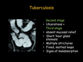Tuberculosis
Second stage
• Ulcerations +
Third stage
• absent mucosal relief
• Short ‘hour glass’
stenosis
• Multiple strictures
• Fixed, matted loops
• Signs of malabsorption
 
