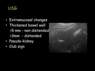 USG
• Extramucosal changes
• Thickened bowel wall
>5 mm - non-distended
>3mm - distended
• Pseudo-kidney
• Club sign
 