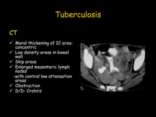 Tuberculosis
CT
 Mural thickening of IC area-
concentric
 Low density areas in bowel
wall
 Skip areas
 Enlarged mesenteric lymph
nodes
-with central low attenuation
areas
 Obstruction
 D/D- Crohn’s
 