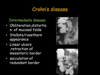 Crohn’s disease
Intermediate disease
• Obliteration,distortio
n of mucosal folds
• Stellate/rosethorn
appearance
• Linear ulcers
,retraction of
mesenteric border
• sacculation of
redundant border
 