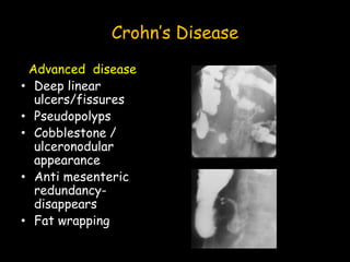 Crohn’s Disease
Advanced disease
• Deep linear
ulcers/fissures
• Pseudopolyps
• Cobblestone /
ulceronodular
appearance
• Anti mesenteric
redundancy-
disappears
• Fat wrapping
 