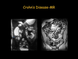 Crohn’s Disease-MR
 