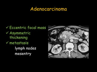 Adenocarcinoma
 Eccentric focal mass
 Asymmetric
thickening
 metastasis
lymph nodes
mesentry
 