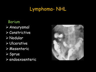 Lymphoma- NHL
Barium
 Aneurysmal
 Constrictive
 Nodular
 Ulcerative
 Mesenteric
 Sprue
 endoexoenteric
 