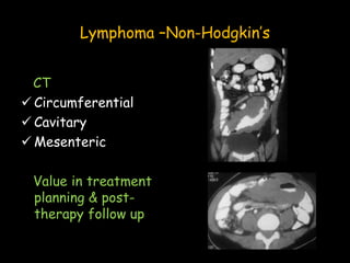 Lymphoma –Non-Hodgkin’s
CT
 Circumferential
 Cavitary
 Mesenteric
Value in treatment
planning & post-
therapy follow up
 