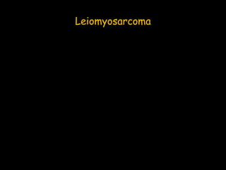 Leiomyosarcoma
 