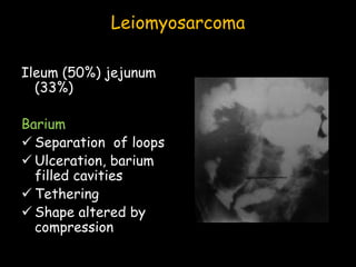 Leiomyosarcoma
Ileum (50%) jejunum
(33%)
Barium
 Separation of loops
 Ulceration, barium
filled cavities
 Tethering
 Shape altered by
compression
 
