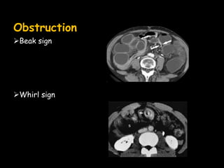 Obstruction
Beak sign
Whirl sign
 