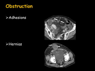 Obstruction
Adhesions
Hernias
 