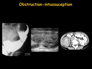 Obstruction-intussuception
 