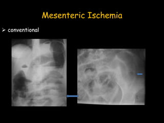 Mesenteric Ischemia
 conventional
 