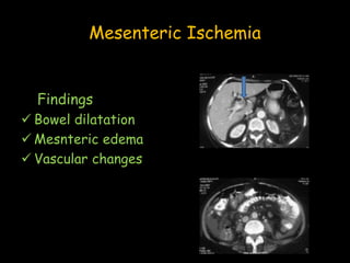 Mesenteric Ischemia
Findings
 Bowel dilatation
 Mesnteric edema
 Vascular changes
 